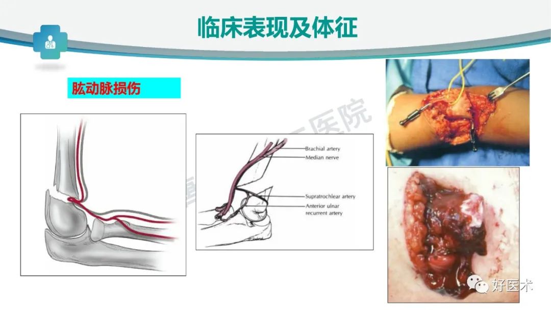 儿童肱骨髁上骨折的诊断与治疗