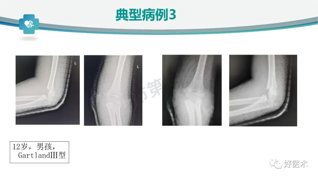 儿童肱骨髁上骨折的诊断与治疗