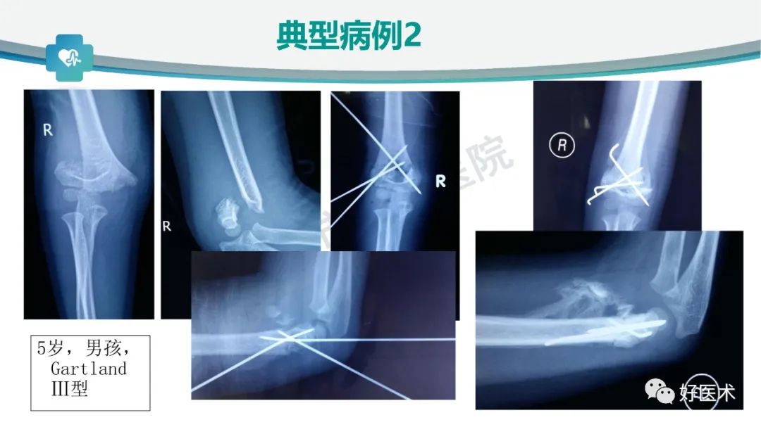 儿童肱骨髁上骨折的诊断与治疗