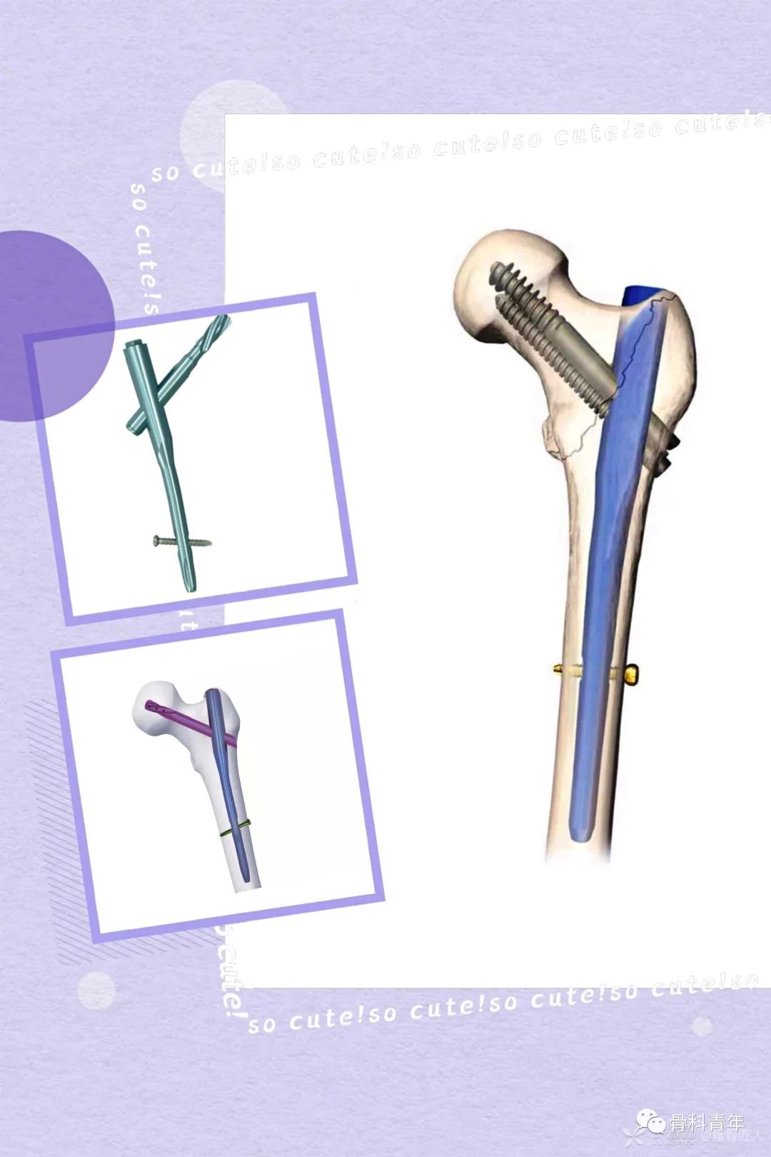 实战经验：髓内钉固定治疗股骨转子间骨折10条推荐（下篇
