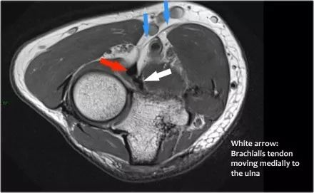 肘关节常见病的MRI图谱详解