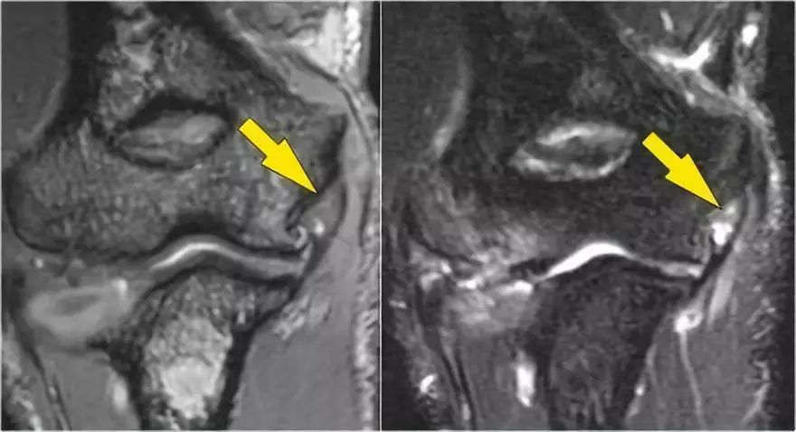 肘关节常见病的MRI图谱详解