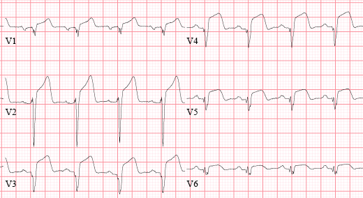 心内必知的5类心梗心电图，你都掌握了吗？