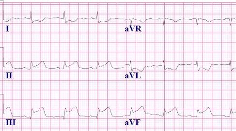心内必知的5类心梗心电图，你都掌握了吗？