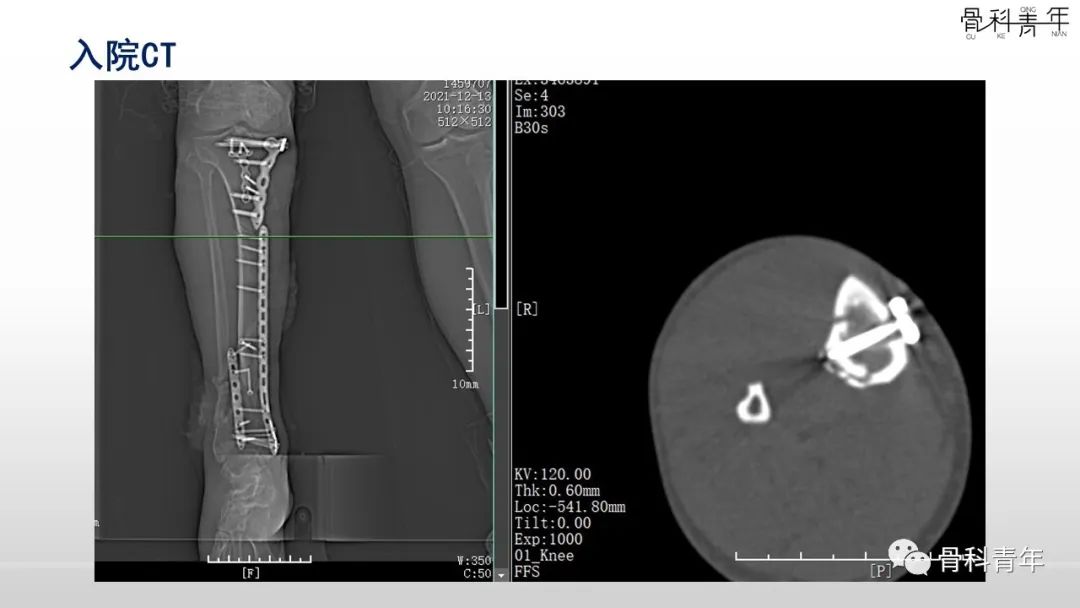 病例分享：胫腓骨多次骨折ORIF术后再骨折