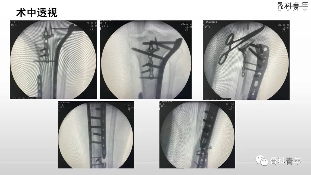 病例分享：胫腓骨多次骨折ORIF术后再骨折