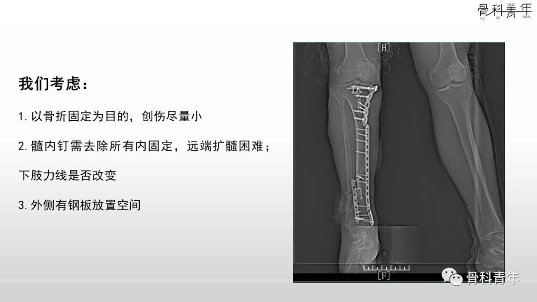 病例分享：胫腓骨多次骨折ORIF术后再骨折