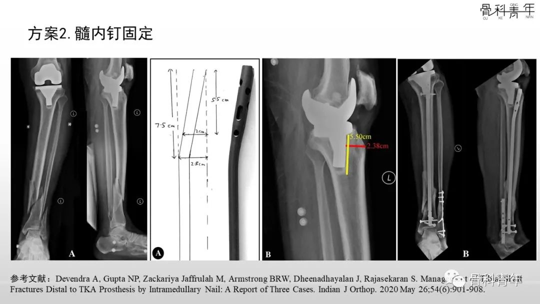 病例分享：胫腓骨多次骨折ORIF术后再骨折