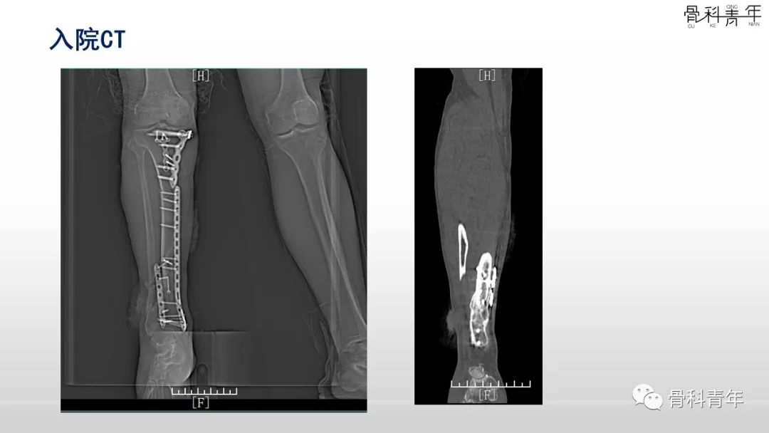 病例分享：胫腓骨多次骨折ORIF术后再骨折