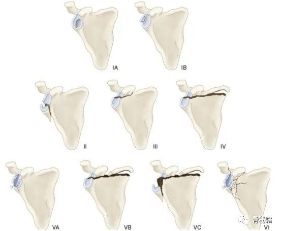 肩盂骨折分型与入路