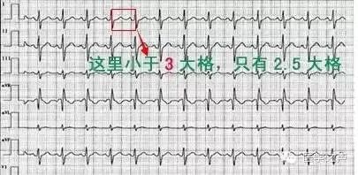 一文详解临床常见的11种心电图