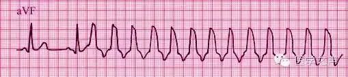 一文详解临床常见的11种心电图