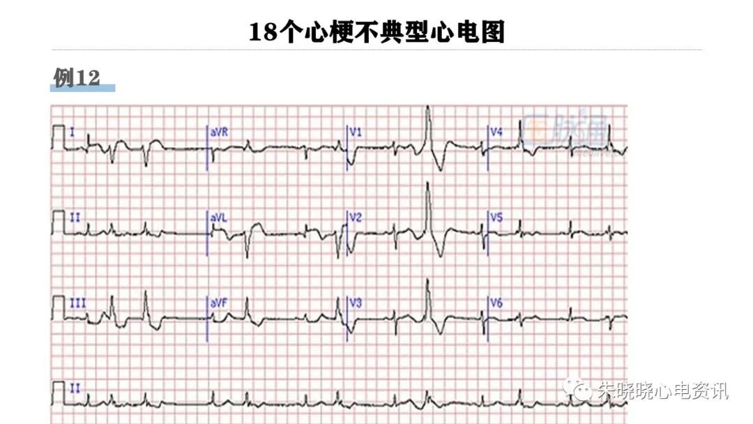 18个心梗不典型心电图（PPT）