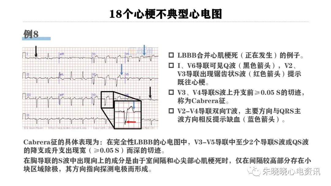 18个心梗不典型心电图（PPT）