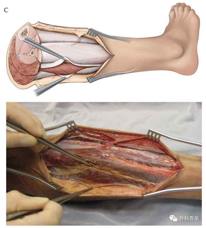 图解：小腿骨筋膜室综合征单切口减压技术