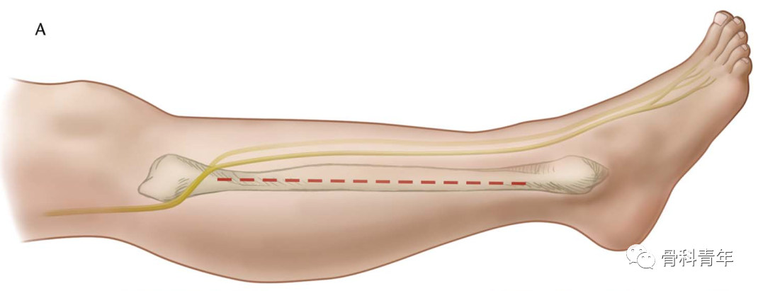 图解：小腿骨筋膜室综合征单切口减压技术