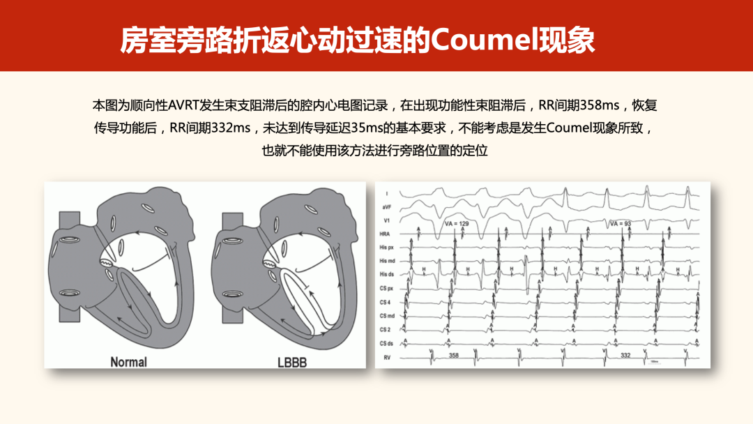 什么是心律失常中的Coumel现象？