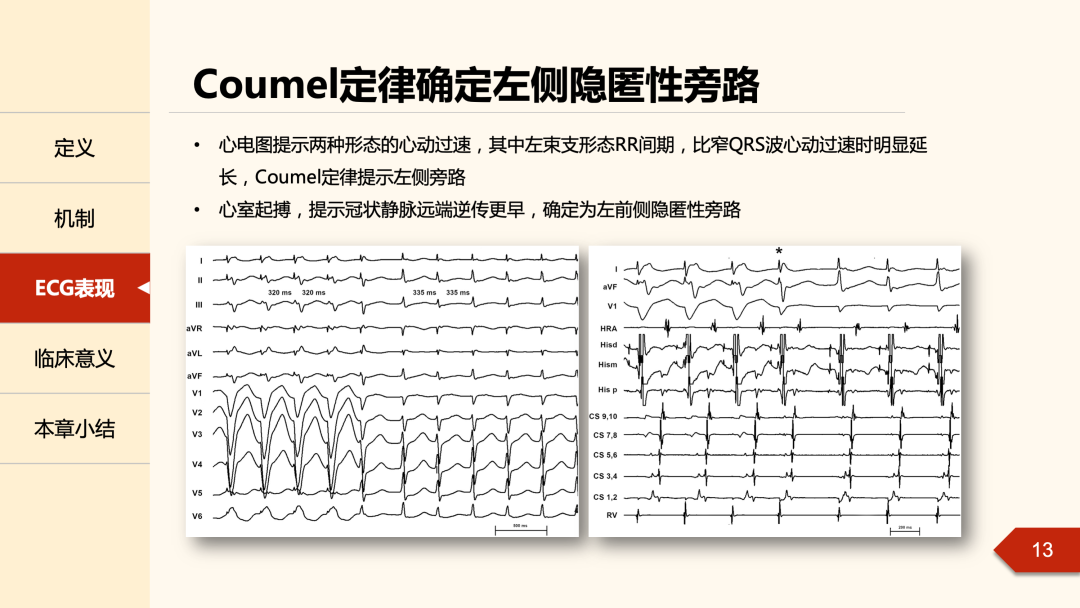 什么是心律失常中的Coumel现象？