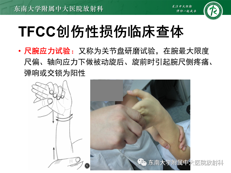腕关节三角纤维软骨复合体（TFCC）解剖及创伤性损伤的影像表现