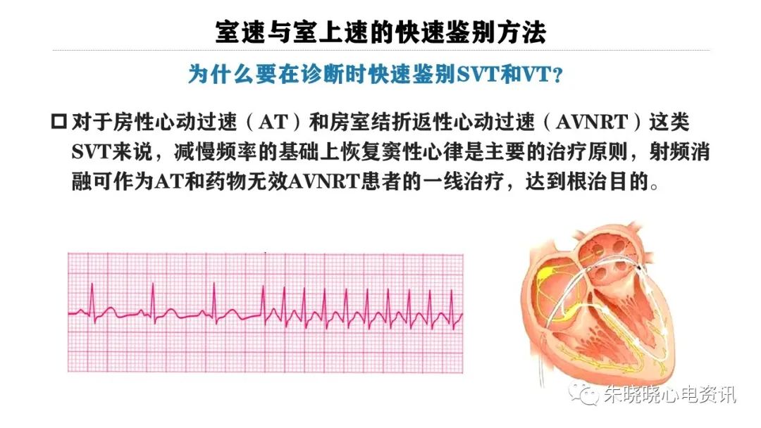 一看就会！室速与室上速的快速鉴别方法