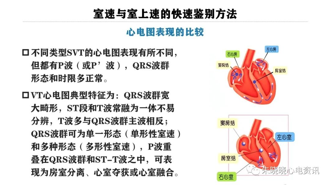 一看就会！室速与室上速的快速鉴别方法