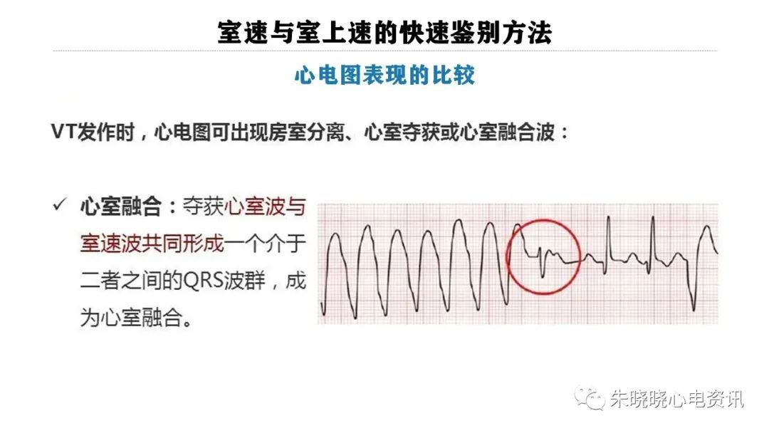 一看就会！室速与室上速的快速鉴别方法