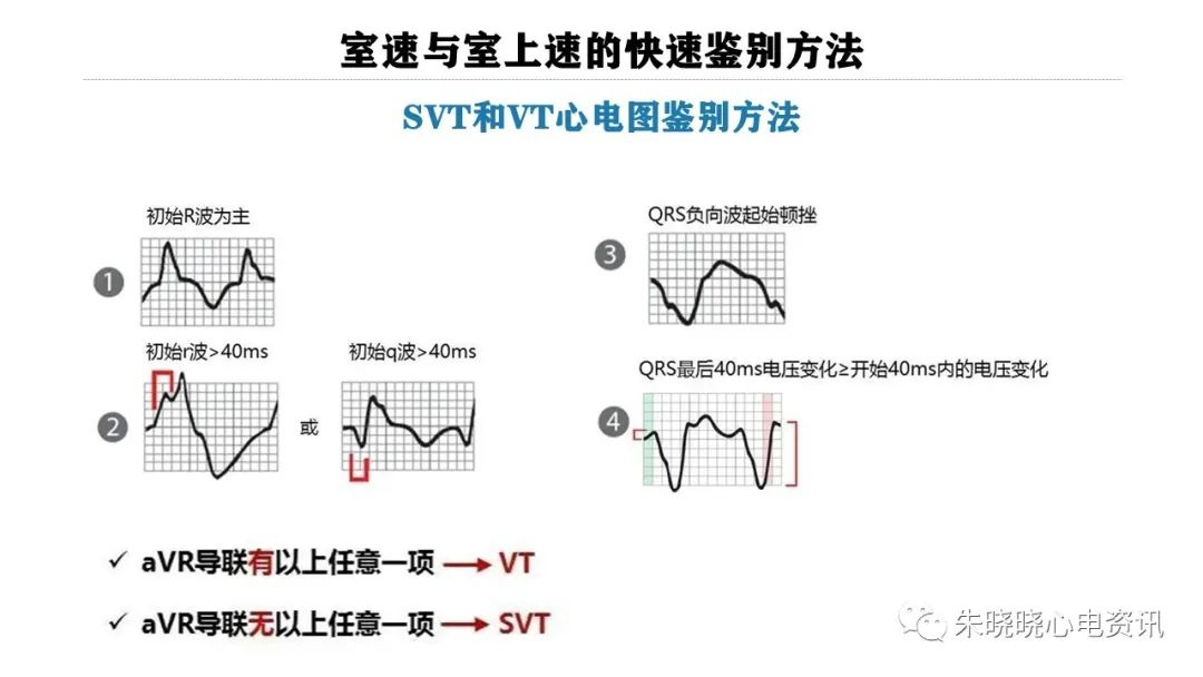 一看就会！室速与室上速的快速鉴别方法