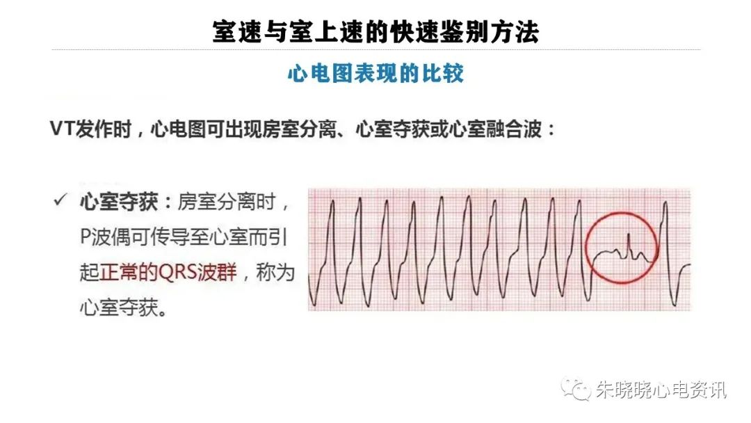 一看就会！室速与室上速的快速鉴别方法