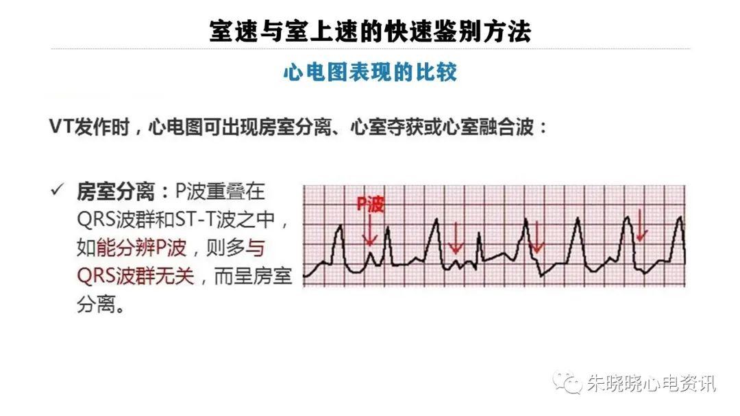 一看就会！室速与室上速的快速鉴别方法