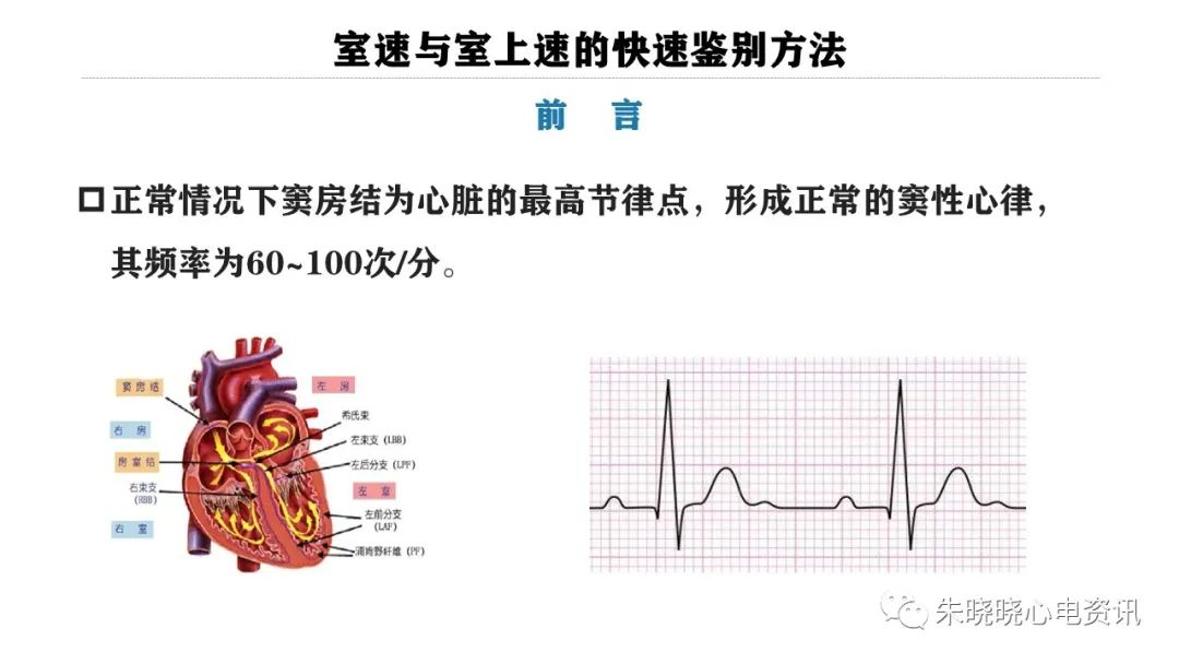 一看就会！室速与室上速的快速鉴别方法