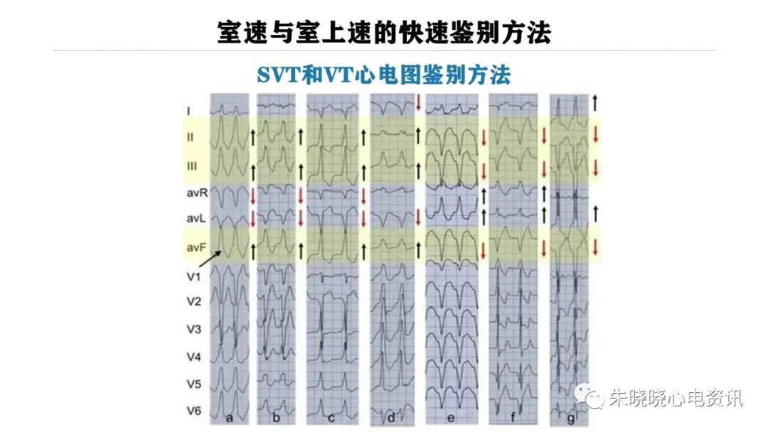 一看就会！室速与室上速的快速鉴别方法