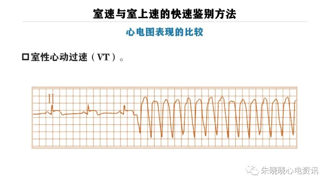 一看就会！室速与室上速的快速鉴别方法