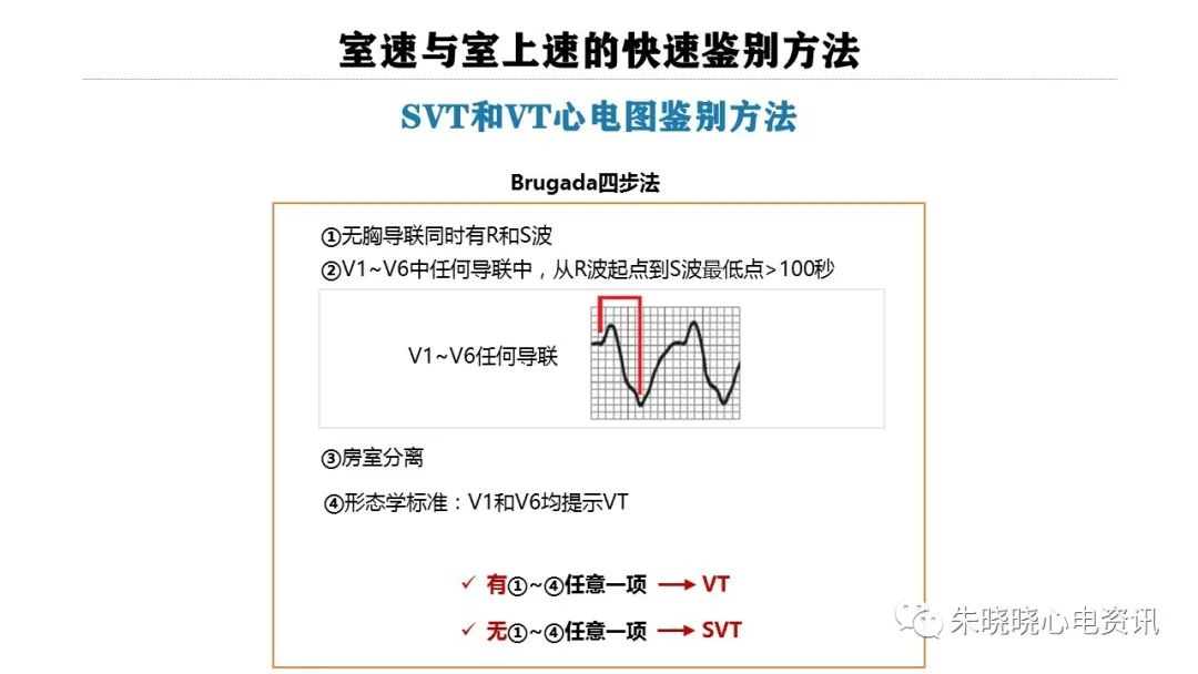 一看就会！室速与室上速的快速鉴别方法