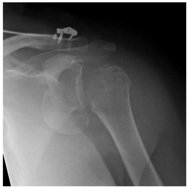 合并结节骨折的肩关节脱位，在急诊室直接复位安全吗？