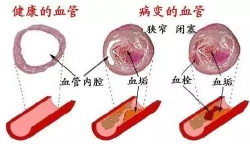 【5·18血管健康日】别再默默喂养血栓了！血管就是这么一天天被堵死的！