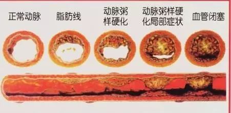 【5·18血管健康日】别再默默喂养血栓了！血管就是这么一天天被堵死的！