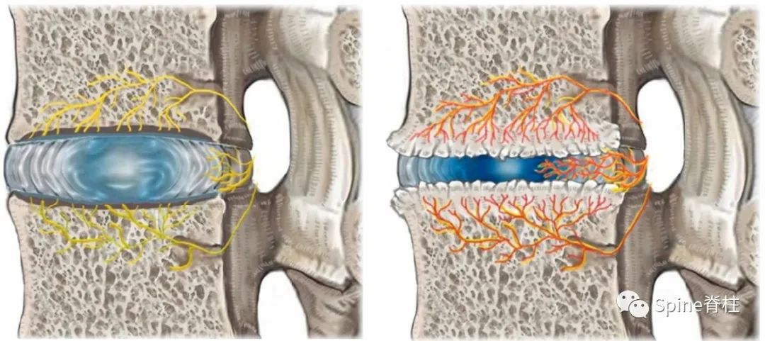 椎体内椎基神经射频消融术治疗疼痛性Modic改变
