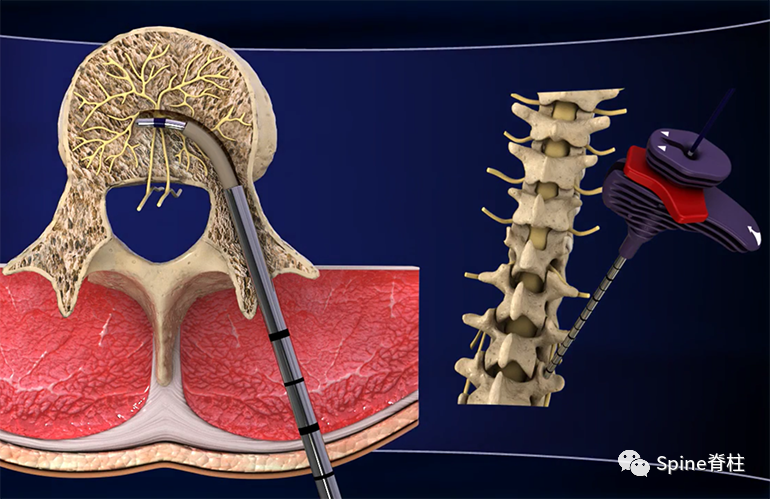 椎体内椎基神经射频消融术治疗疼痛性Modic改变