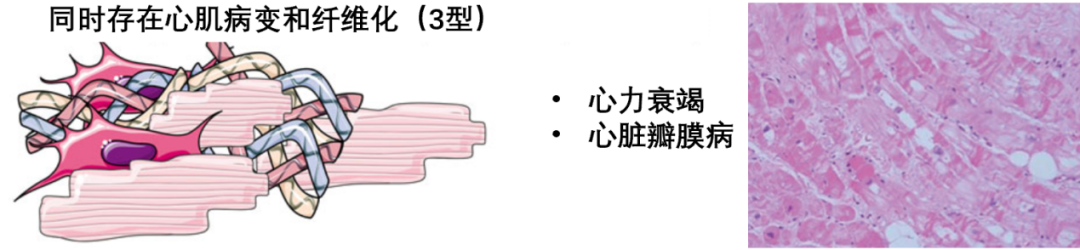 一文读懂心房心肌病