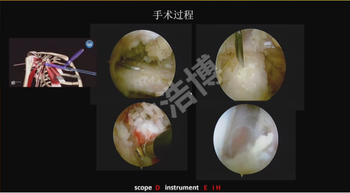 肩关节脱位“新认识”