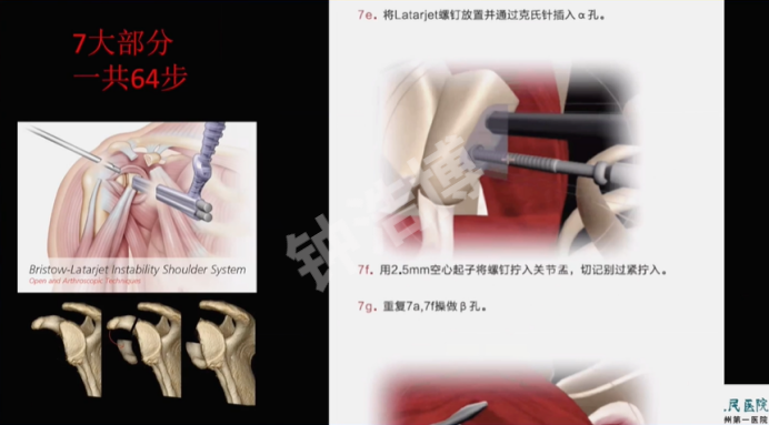 肩关节脱位“新认识”