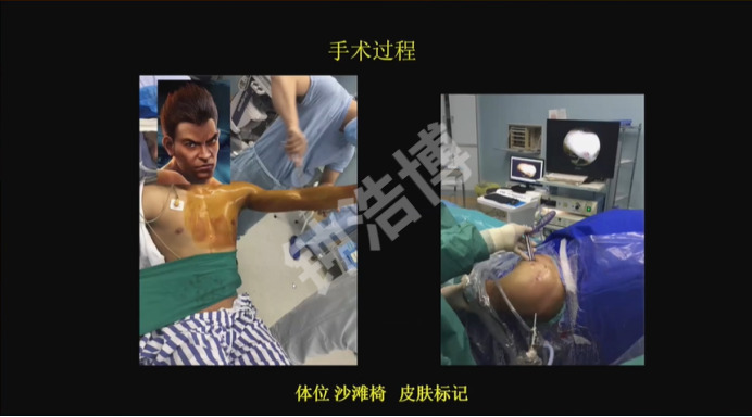 肩关节脱位“新认识”