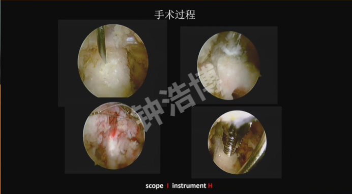 肩关节脱位“新认识”