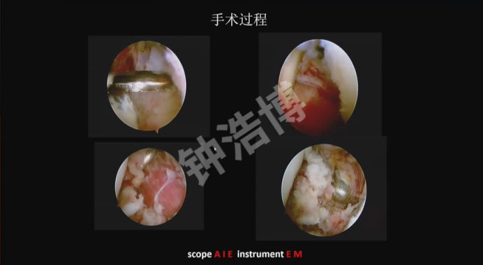 肩关节脱位“新认识”
