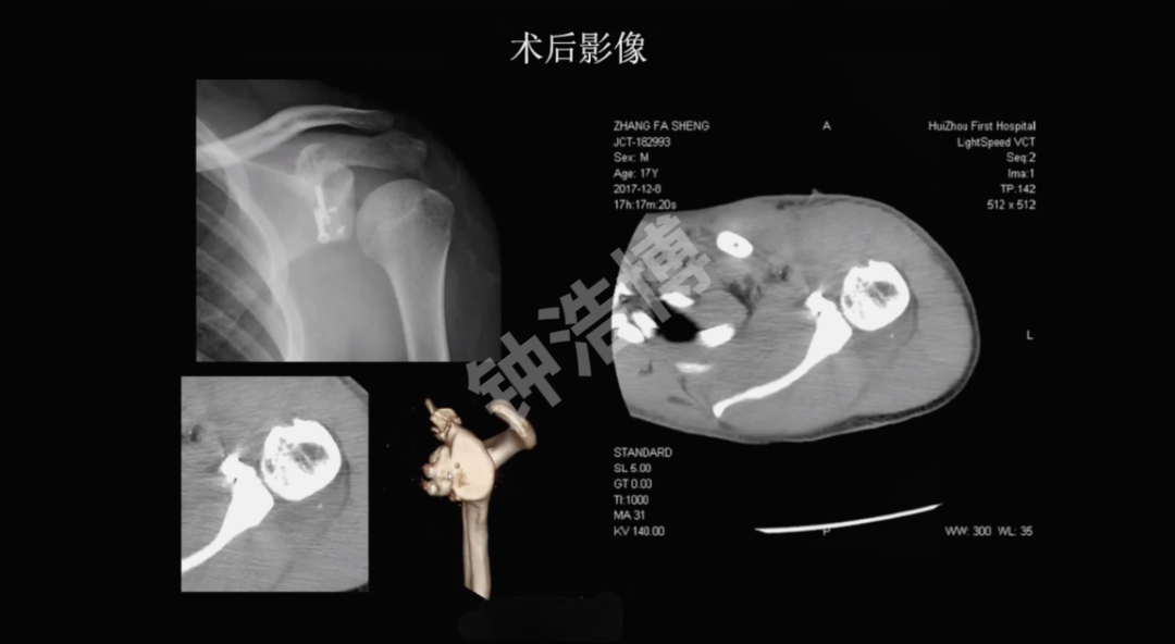 肩关节脱位“新认识”