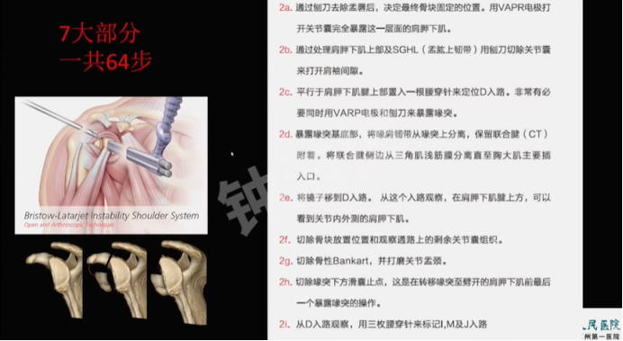 肩关节脱位“新认识”