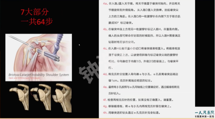 肩关节脱位“新认识”