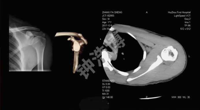 肩关节脱位“新认识”