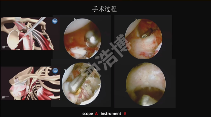 肩关节脱位“新认识”