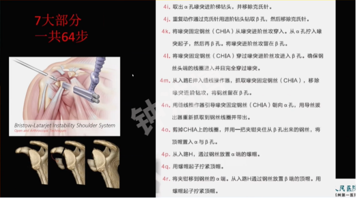 肩关节脱位“新认识”